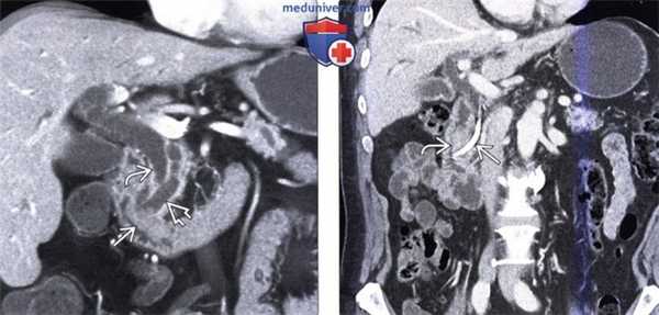 КТ, МРТ, УЗИ признаки рака ампулы фатерова сосочка