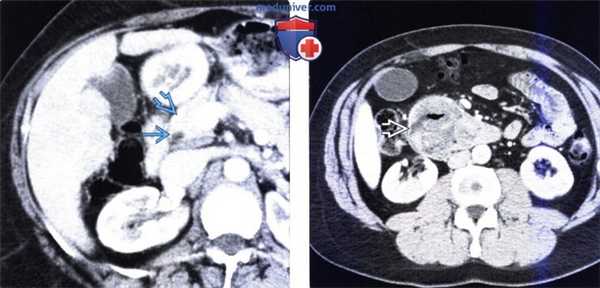 Рентгенограмма, КТ, МРТ, УЗИ при раке двенадцатиперстной кишки