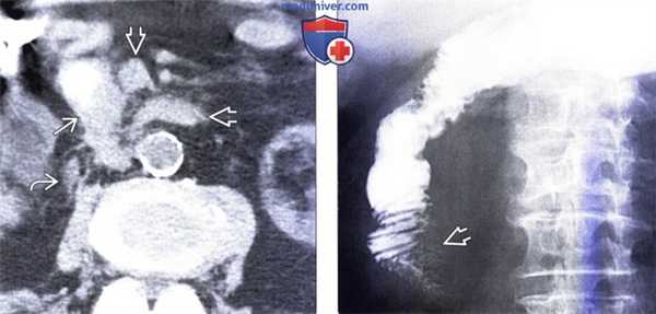 Рентгенограмма, КТ, МРТ, УЗИ при раке двенадцатиперстной кишки