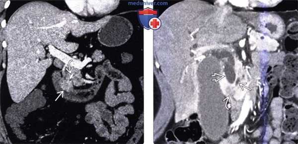 КТ, МРТ, УЗИ признаки рака ампулы фатерова сосочка