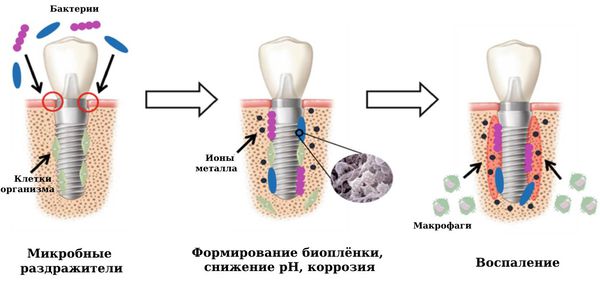 Формирование биоплёнки на имплантате [22]