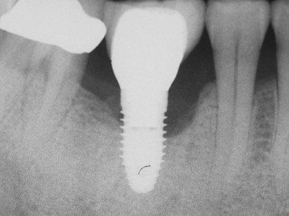 Периимплантит на рентгенограмме [18]