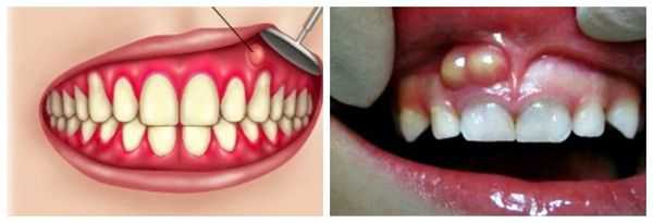 Абсцесс десны