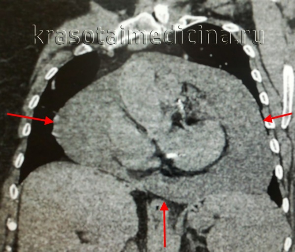 КТ ОГК. Экссудативный перикардит. Значительное количество жидкости в полости перикарда.