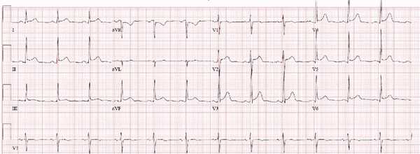 ЭКГ при перикардите
