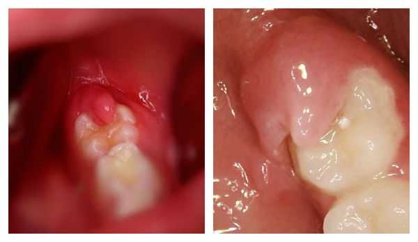 Острый и хронический перикоронит