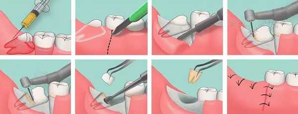 Удаление зуба мудрости