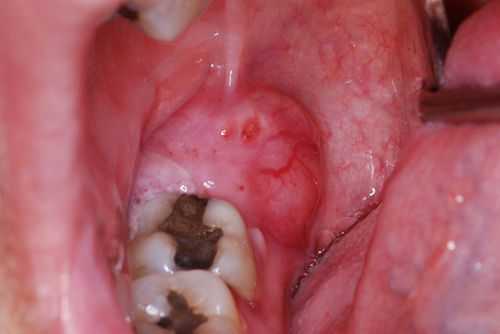 Позадимолярный абсцесс