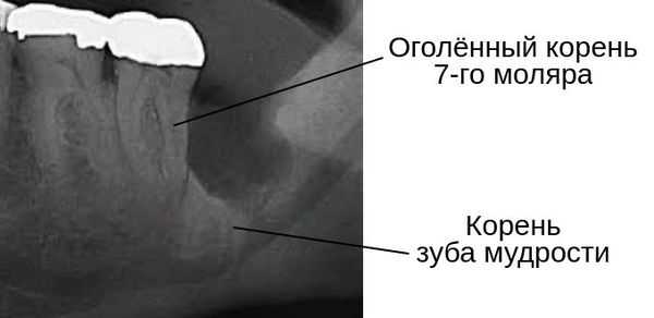 Оголение корня соседнего моляра после удаления зуба мудрости