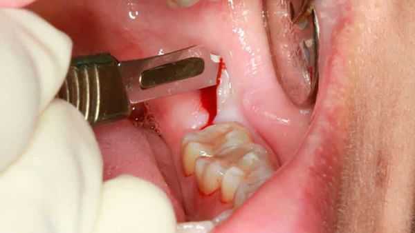 Иссечение капюшона