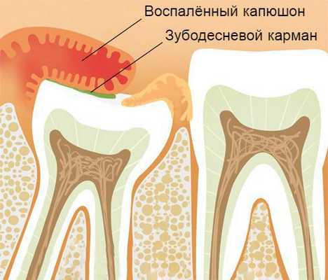 Воспалённый капюшон и зубодесневой карман