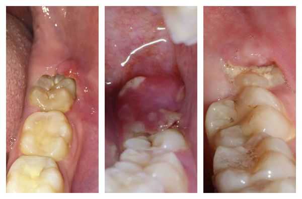 Катаральный, язвенный и гнойный перикоронит (слева направо)