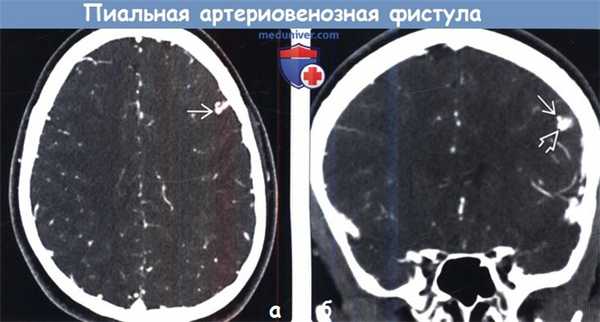 Пиальная артериовенозная фистула по КТ, ангиограмме
