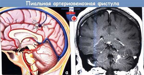 Пиальная артериовенозная фистула по МРТ