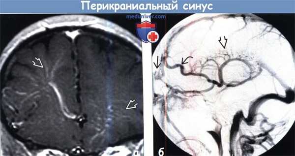 Перикраниальный синус на МРТ, ангиограмме