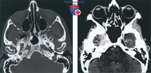 КТ, МРТ при периневральной опухоли в жевательном пространстве