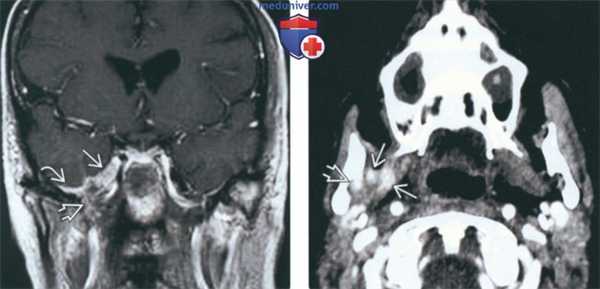 КТ, МРТ при периневральной опухоли в жевательном пространстве