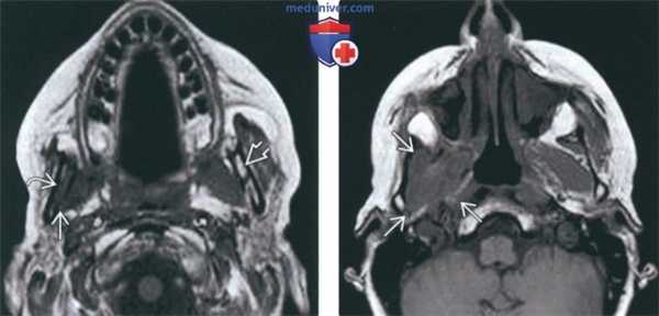 КТ, МРТ при периневральной опухоли в жевательном пространстве
