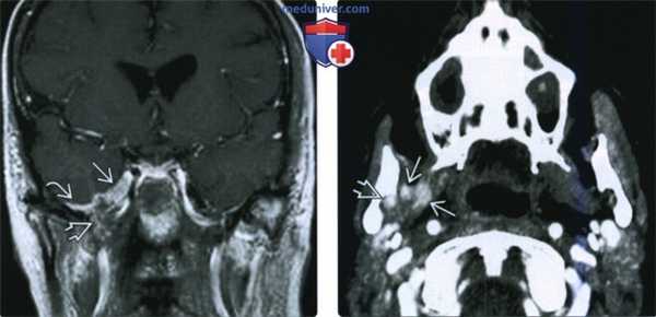 КТ, МРТ при периневральной опухолевой инвазии жевательного пространства по нижнечелюстному нерву
