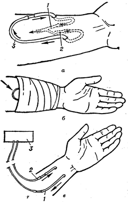 Рис. 1. Схема артерио-венозного шунта на предплечье при хроническом гемодиализе: а— наложение шунта (1 — вена; 2 — артерия; 3 — шунт), стрелки указывают направление движения крови; б — в периоды между гемодиализами шунт находится под повязкой, часть его остается открытой (указано стрелкой) для контроля за кровотоком; в — во время гемодиализа шунт разъединяется и его концы (1 и 2) соединяются с магистралями искусственной почки (3), стрелки указывают направление движения крови.