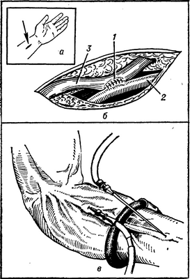 Рис. 2. Схема наложения артерио-венозной фистулы и пункции вены при гемодиализе: а — линия разреза (указана стрелкой); б — наложено соустье (1) между лучевой артерией (2) и подкожной веной (3); в — пункция расширенной вены специальными иглами, соединяемыми с магистралями искусственной почки.