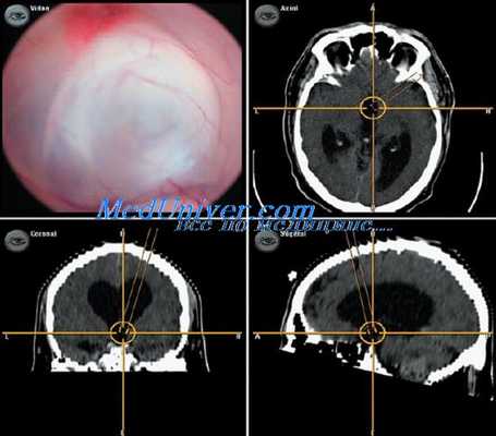 эндоскопические спинальные операции