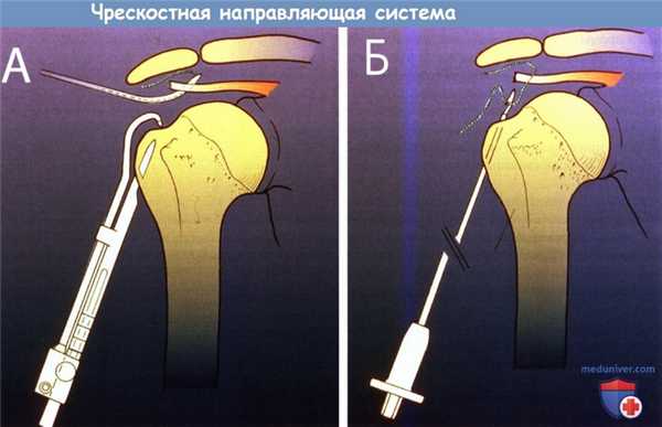 Чрескостная направляющая система