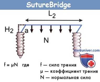 Техника SutureBridge
