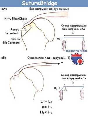 Техника SutureBridge