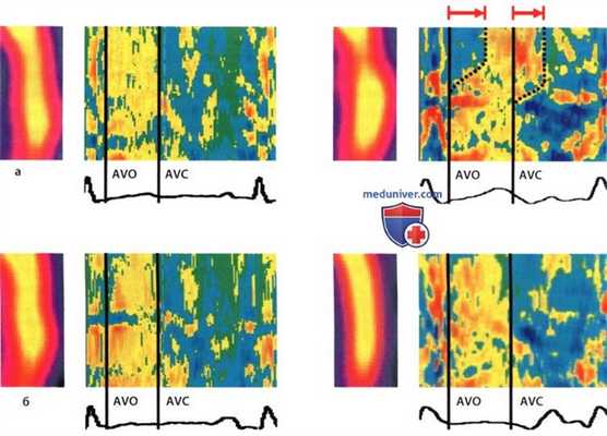 Перспективы развития стресс-ЭхоКГ