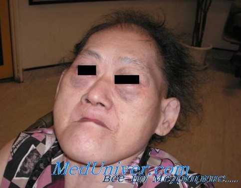 акромегалия