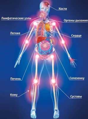 Возможные осложнения при лимфоме средостения