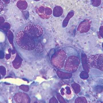 Лимфомы средостения