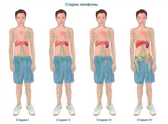 Стадии развития болезни