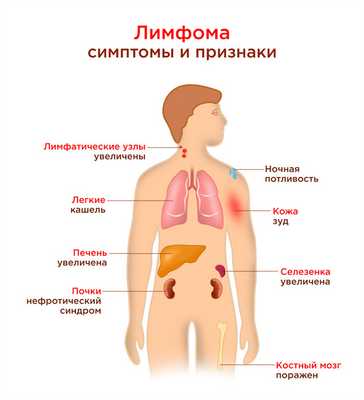 Симптомы лимфомы