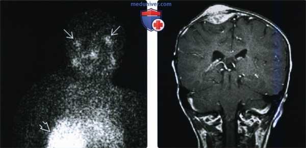 КТ, МРТ при метастатической нейробластоме головы и шеи