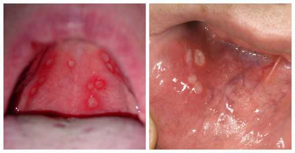 Афты, возникающие при герпетическом стоматите
