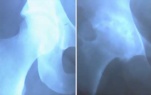 Артроз коленного сустава фото