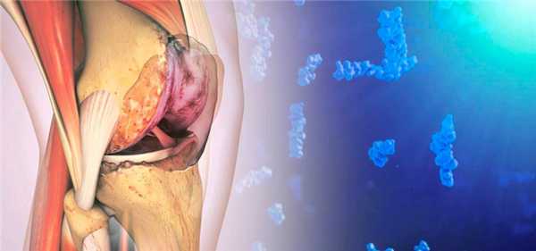 Остеоартроз коленного сустава