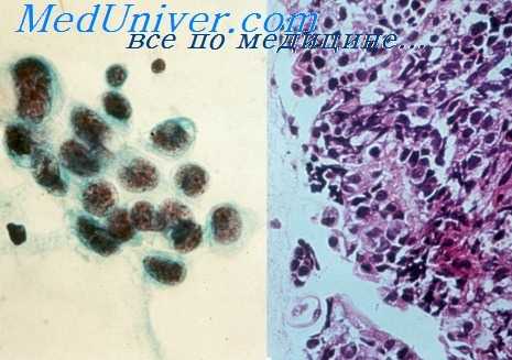 виды сифилиса