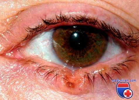 сифилома века глаза