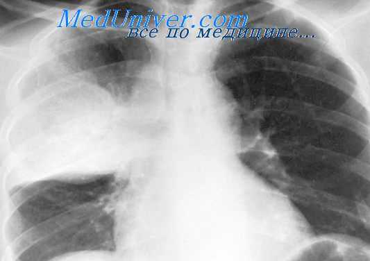 первичный туберкулез