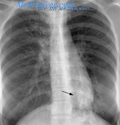 первичный туберкулез