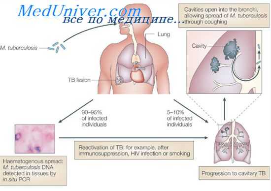 туберкулезный комплекс
