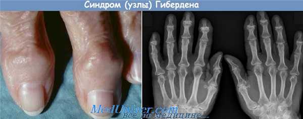 Узлы Гебердена и Бушара