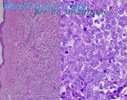 первично-множественные опухоли