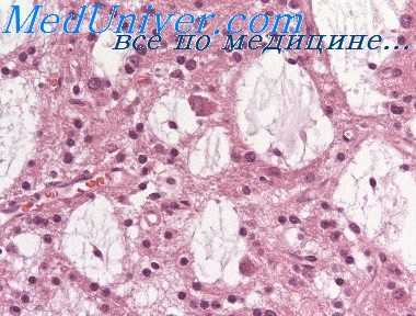 первично-множественные опухоли