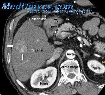 первично-множественные опухоли