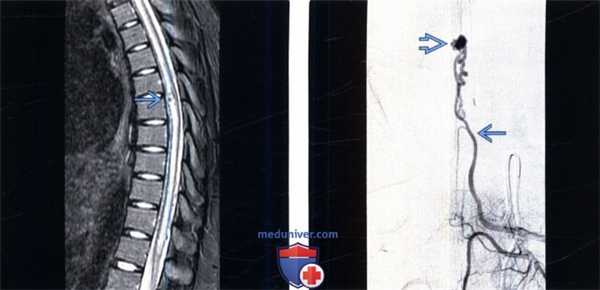 МРТ при сосудистой мальформации 4 типа позвоночника (артериовенозной фистуле, АВФ)