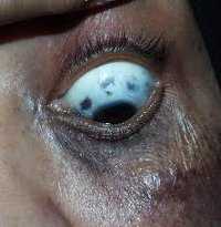 Невус Беккера